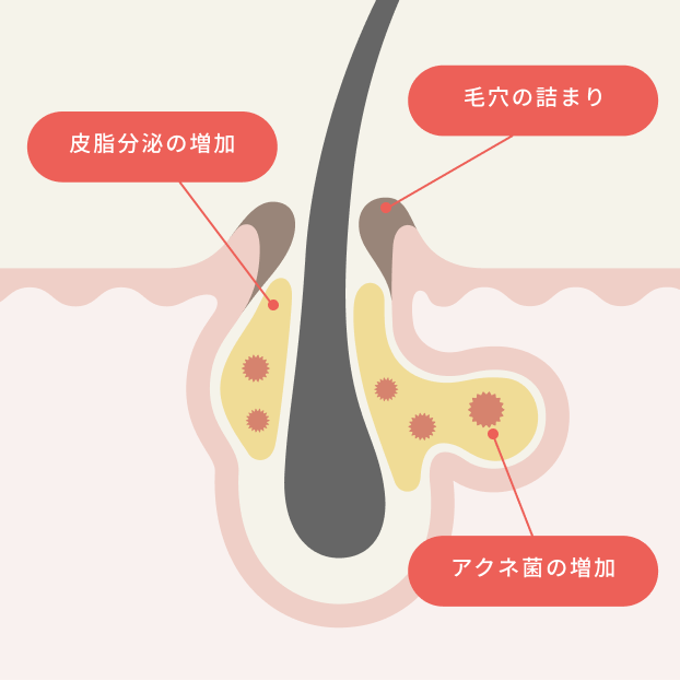 ニキビになる原因